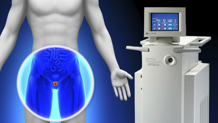 Holmium LASER: conheça o novo tratamento para o aumento benigno da próstata