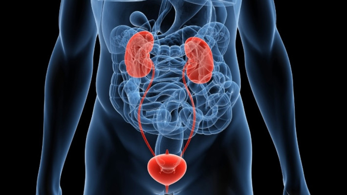 Litíase Renal